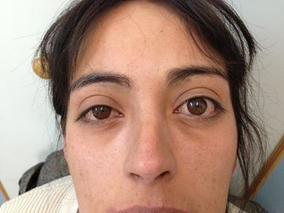 Efectos del hipotiroidismo en los ojos